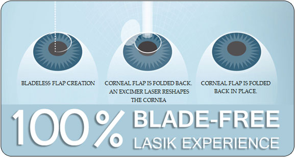 Lasik surgery Denver